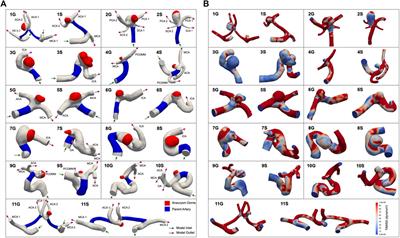 A matched-pair case control study identifying hemodynamic predictors of cerebral aneurysm growth using computational fluid dynamics